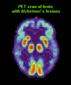 PET-scan-Alzheimers