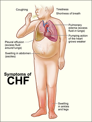 chf-heart-failure